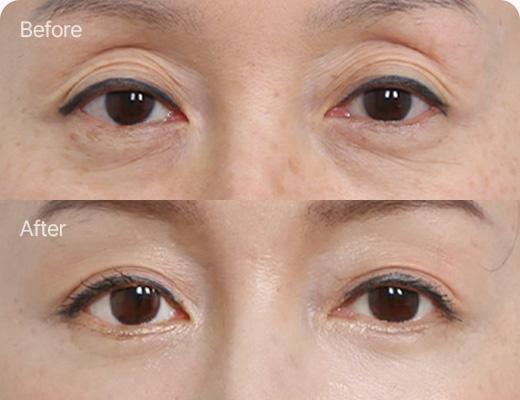 하안검 전후사진 하안검 후기