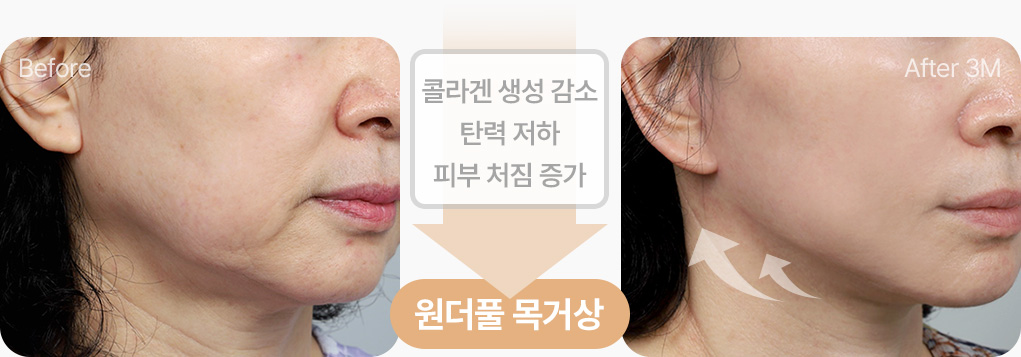 원더풀 목거상 콜라겐 생성감소 탄력 저하 피부처짐증가 해결 원더풀 목거상