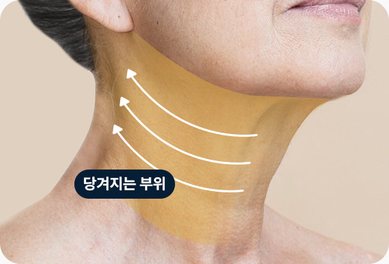 이마거상 전후사진 이마거상후기 처진눈썹 리프팅