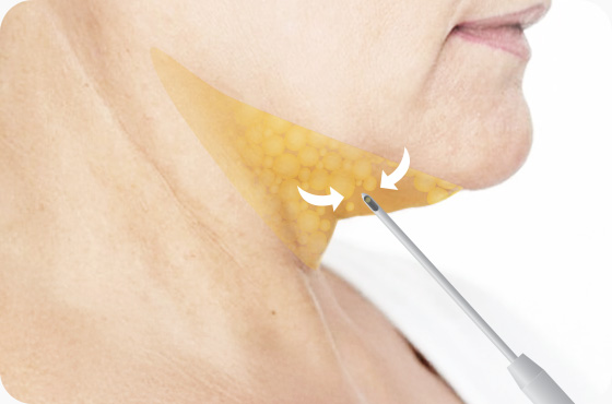 이마거상 전두근 추미근 눈썹내림근 섬세한 절개 및 박리 