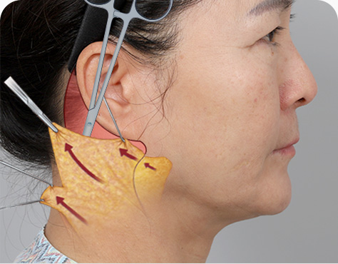 원더풀 목거상 활경근과 피부, 지방, 근막(SMAS)층을 박리 지방흡입