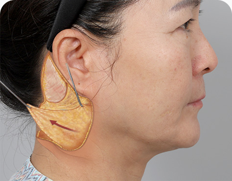 원더풀 목거상 피부, 근막(SMAS), 근육 재배치 고정