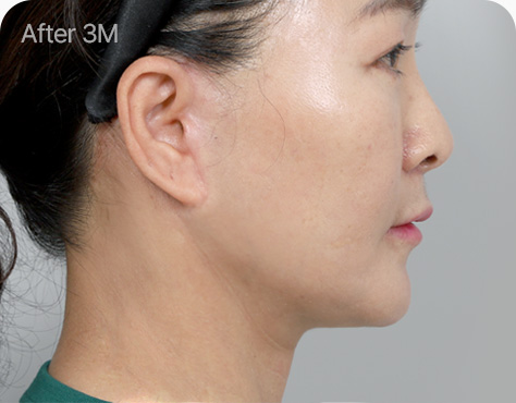 원더풀 목거상 남은 조직 제거 봉합