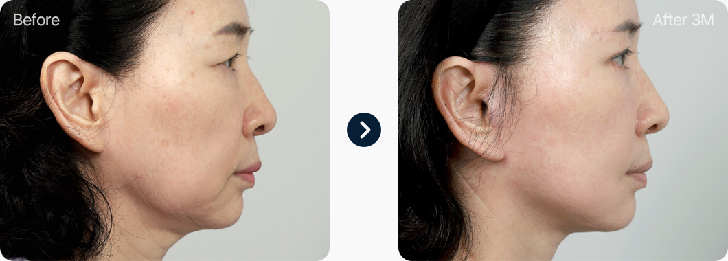 원더풀 목거상 전후사진 목거상후기