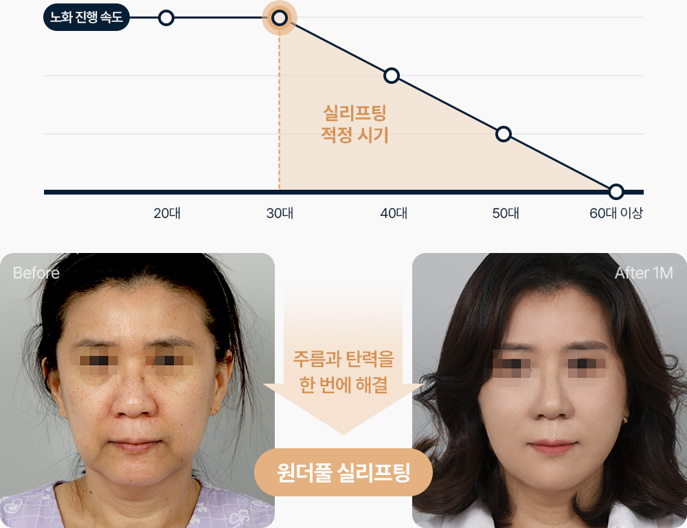 실리프팅 노화진행속도 30대부터 실리프팅 적정시기 주름과 탄력을 한번에 해결