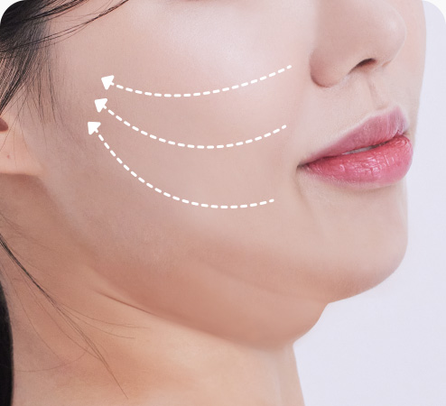 실리프팅 수술방법 리프팅 방향 디자인