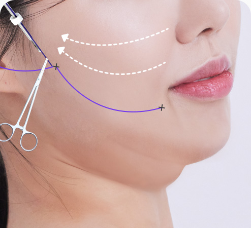 실리프팅 수술방법 적당한 길이 남기고 실 컷팅