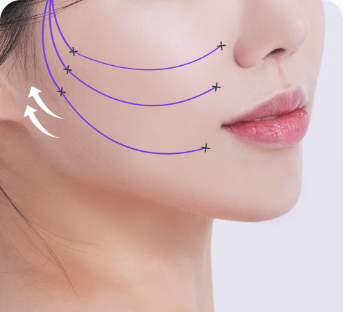 실리프팅 수술방법 삽입된 실을 당겨 처진부위 리프팅