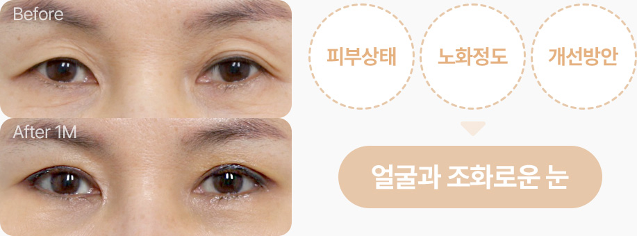 상안검 전후사진 중년상안검 상안검후기 피부상태 노화정도 개선방안 고려한 디자인 얼굴과 조화로운 눈