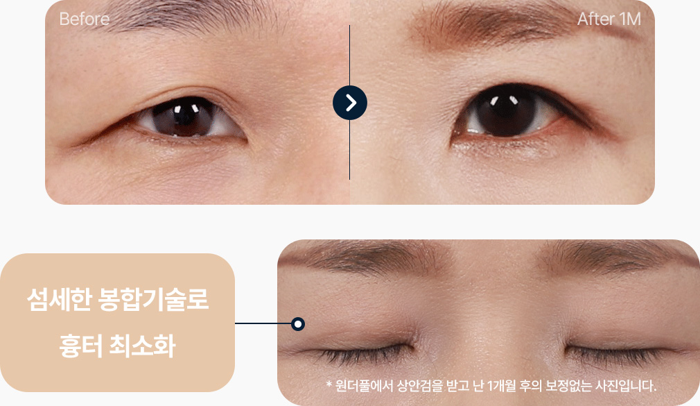 상안검 전후사진 중년상안검 상안검후기 섬세한 봉합기술로 흉터 최소화