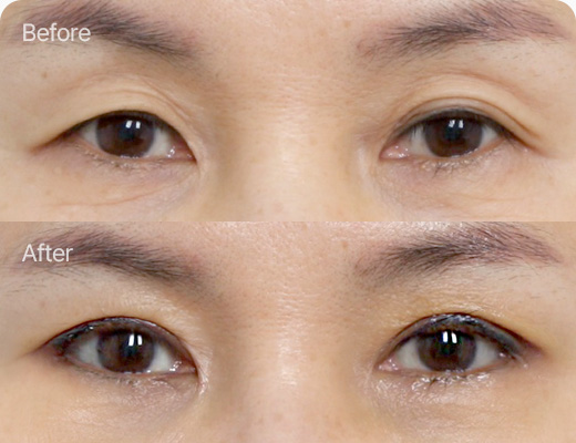 상안검 전후사진 상안검 후기