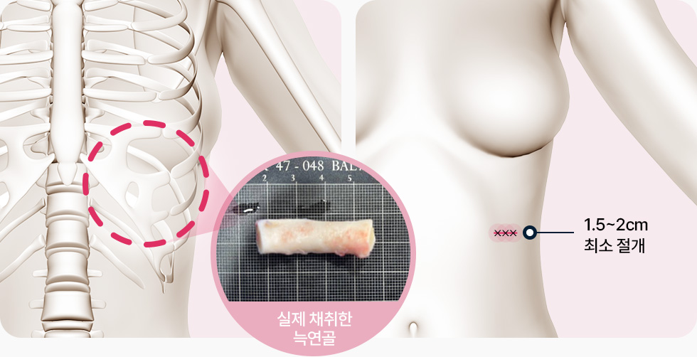 실제 채취한 늑연골 1.5cm 2cm 최소 절개
