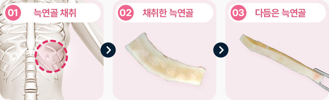 늑연골 채취 채취한 늑연골 다듬은 늑연골