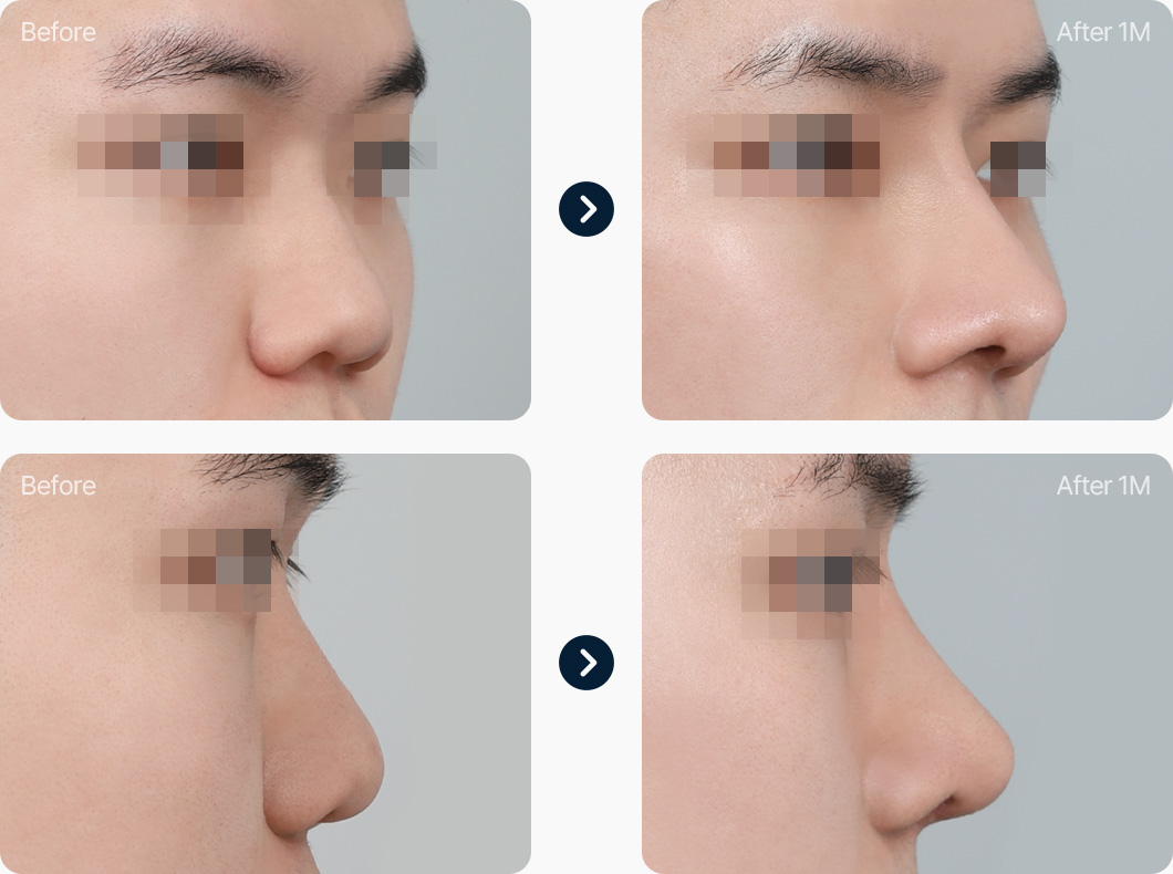 복코 교정 자가늑연골 전후사진