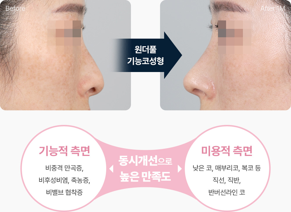기능코성형 전후사진 비중격 만곡증 비후성비염 축농증 비밸브 협착증 낮은코 매부리코 복코 동시개선으로 높은 만족도