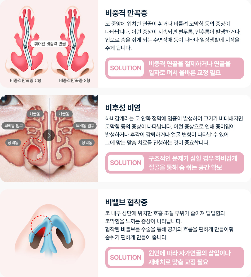 비중격 만곡증 코막힘 증상 편두통 인후통 발생 수면장애 솔루션 비중격 연골 절제 연골을 일자로 펴 교정 비후성 비염 하비갑개 코안쪽 점막 염증 코막힘 중이염 후감 감퇴 얼굴 변형 솔루션 하비갑개 절골 숨쉬는 공간확보 비밸브 협작층 코막힘 증상 솔루션 자가연골 삽입 재배치 맞춤 교정