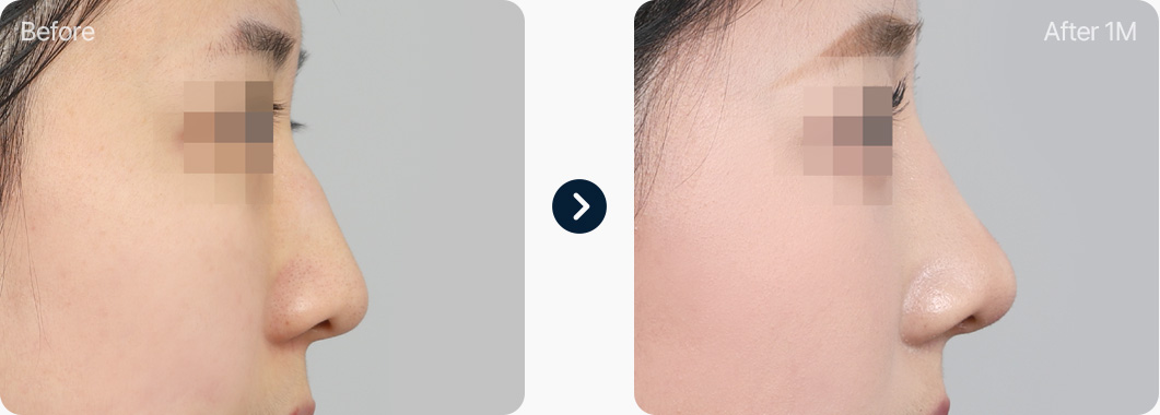 기능코성형 비중격연골+귀연골 전후사진