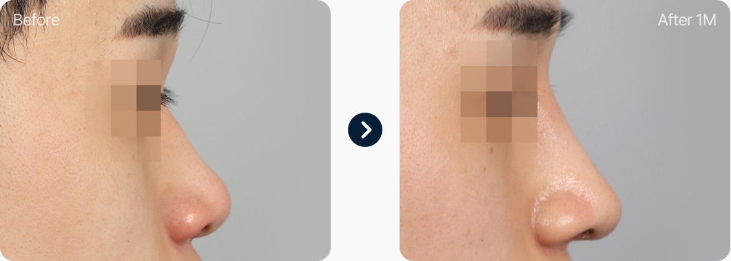 기능코성형 자가늑연골 전후사진