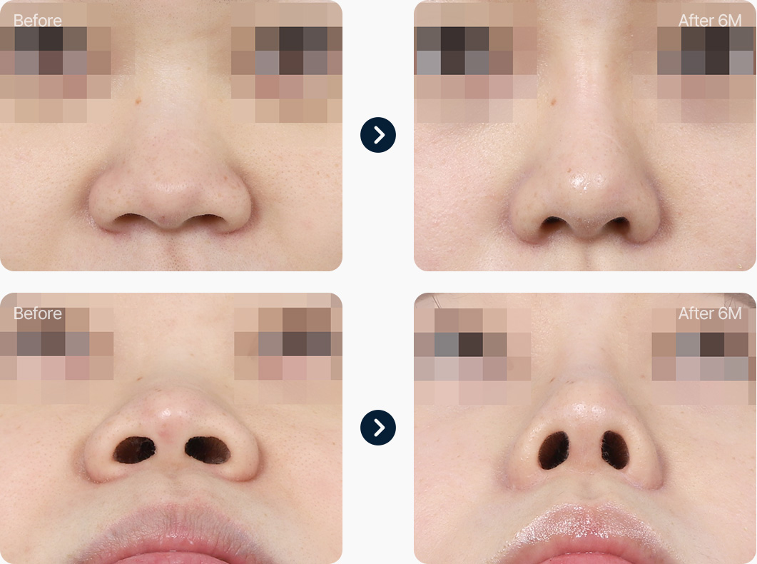 콧볼축소 수술 전후사진