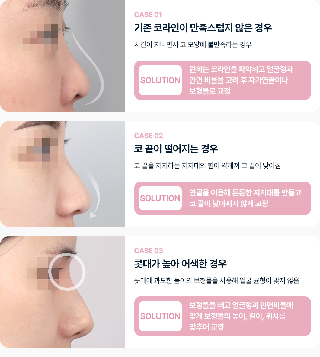 케이스1 기존 코라인 만족스럽지 않은 경우 원하는 코라인 파악 얼굴형 안면비율 고려 후 자가연골이나 보형물로 교정 케이스2 코끝이 떨어지는 경우 연골을 이용해 튼튼한 지지대로 코끝이 낮아지지않게 고정 케이스3 콧대가 높아 어색한 경우 보형물을 제거 얼굴 비율에 맞게 보형물 재교정 