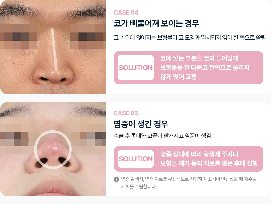 케이스4 코가 삐뚤어져 보이는 경우 보형물을 코에 들어맞게 잘 다듬고 한쪽으로 쏠리지 않게 교정 케이스5 염증이 생긴 경우 항생제 주사나 보형물 제거등으로 치료 후 코재수술 진행