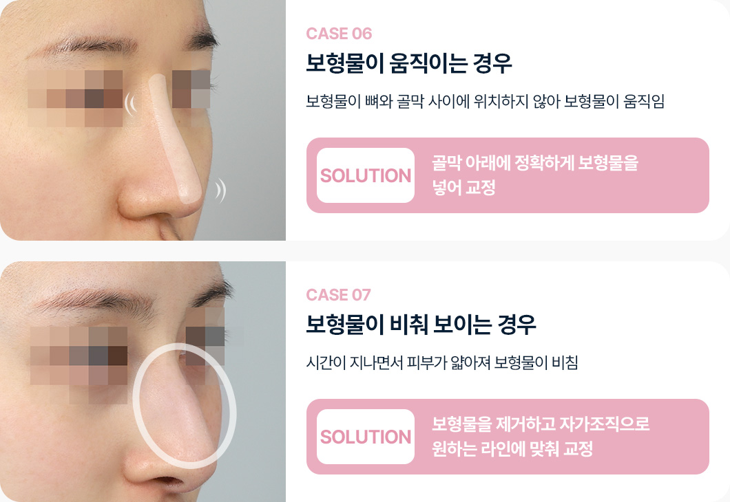 케이스6 보형물이 움직이는 경우 골막 아래 정확히 보형물 교정 케이스7 보형물이 비춰보일때 보형물 제거 자가조직으로 라인에 맞춰 교정