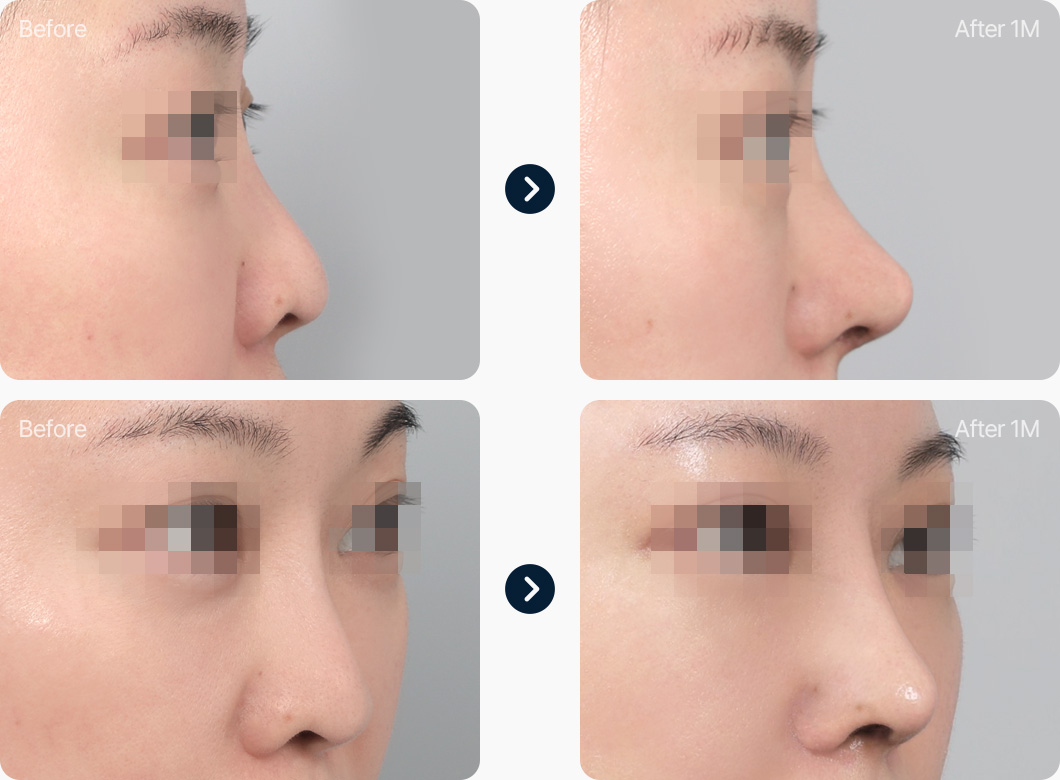 코재수술 전후사진