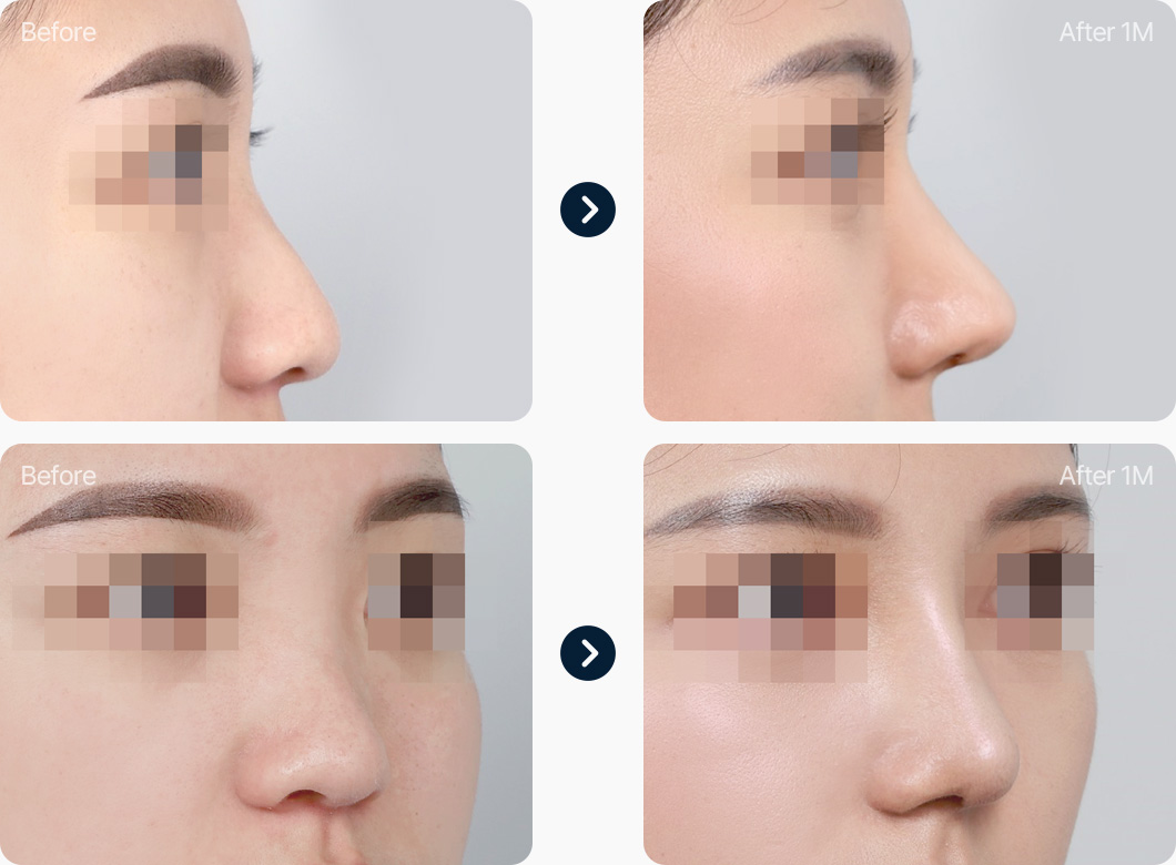 코재수술 전후사진