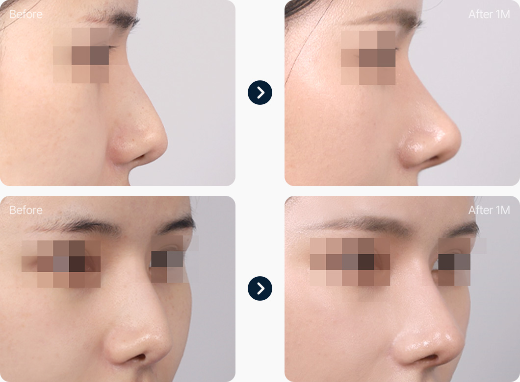 코재수술 전후사진