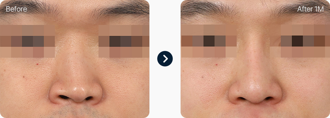 코재수술 전후사진