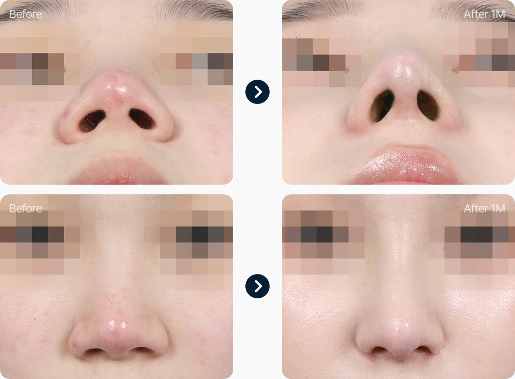 코재수술 전후사진