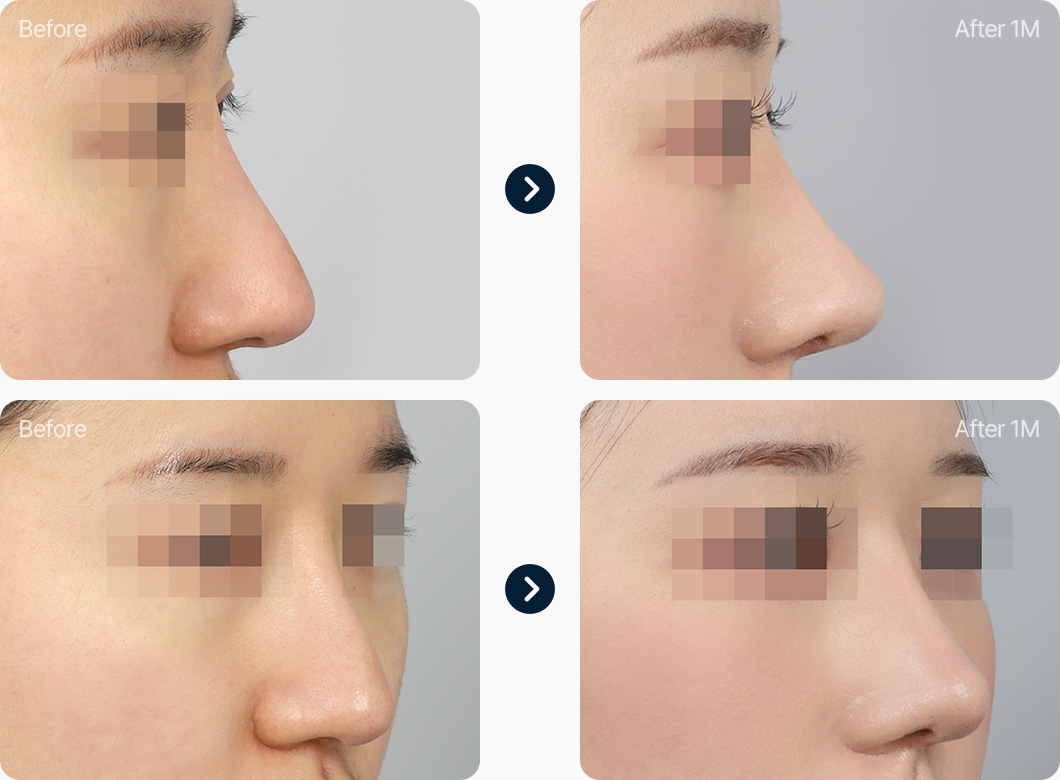 코재수술 전후사진