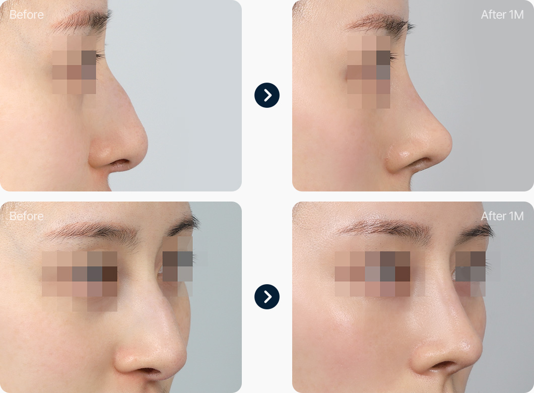 코재수술 전후사진