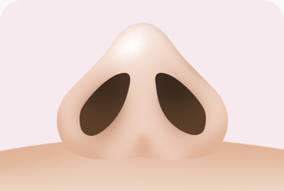 복코 성형 오뚝한 코라인 완성