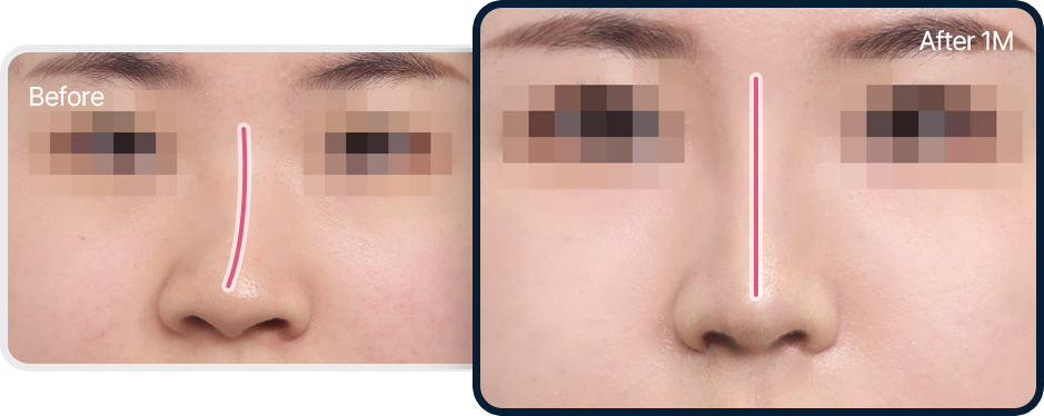 휜코 성형 전후사진