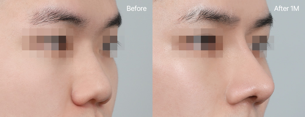 복코성형 자가늑연골 전후사진