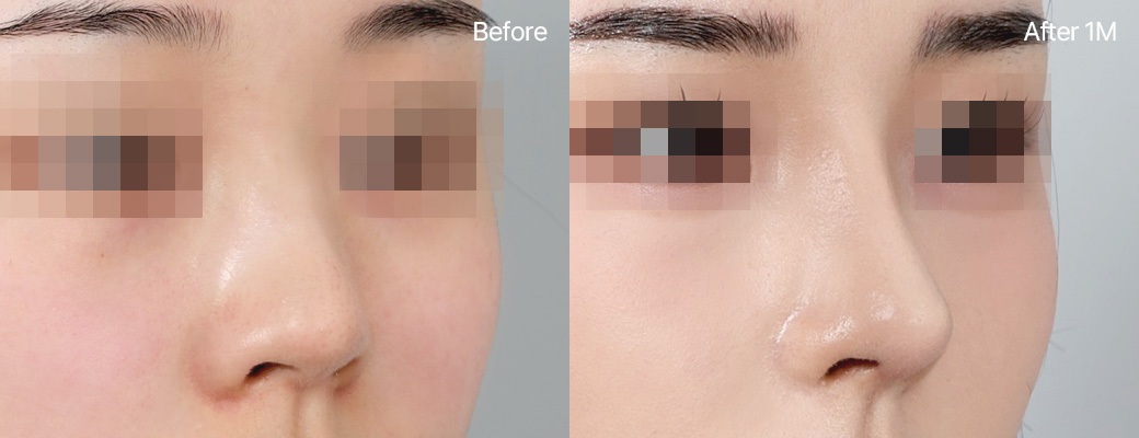 기본코성형 기증늑연골+비중격연골 전후사진