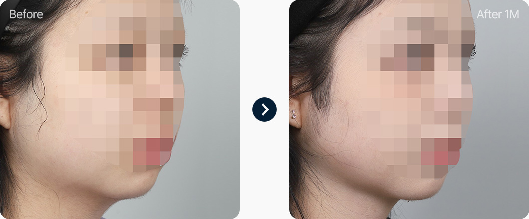 원더풀 윤곽주사 전후사진 윤곽주사효과 윤곽주사후기