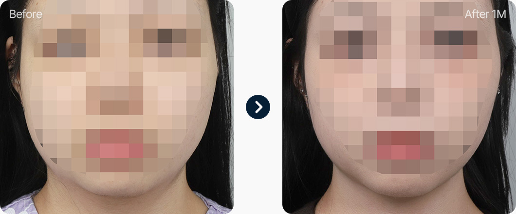 원더풀 윤곽주사 전후사진 윤곽주사효과 윤곽주사후기