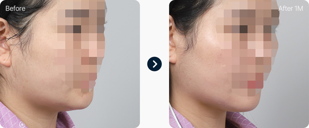 원더풀 윤곽주사 전후사진 윤곽주사효과 윤곽주사후기