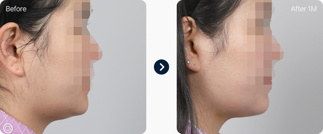 원더풀 윤곽주사 전후사진 윤곽주사효과 윤곽주사후기