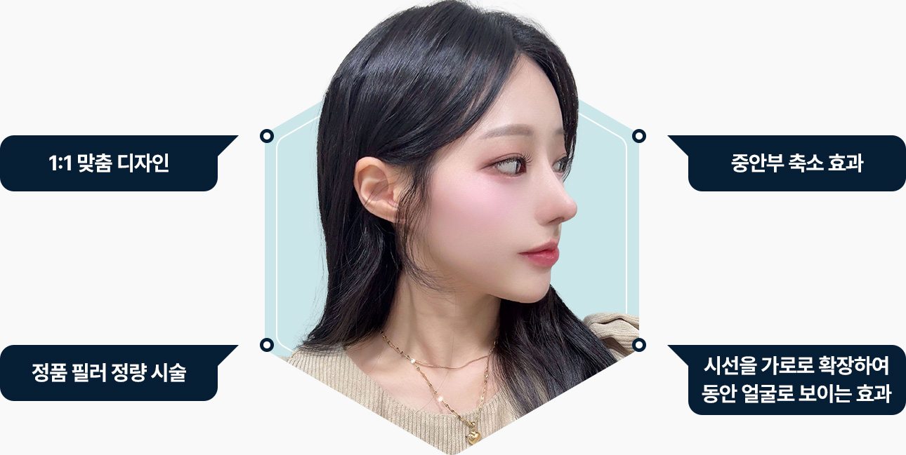 귀필러 맞춤디자인 중안부 축소 정품 귀필러 정량시술 동안 얼굴