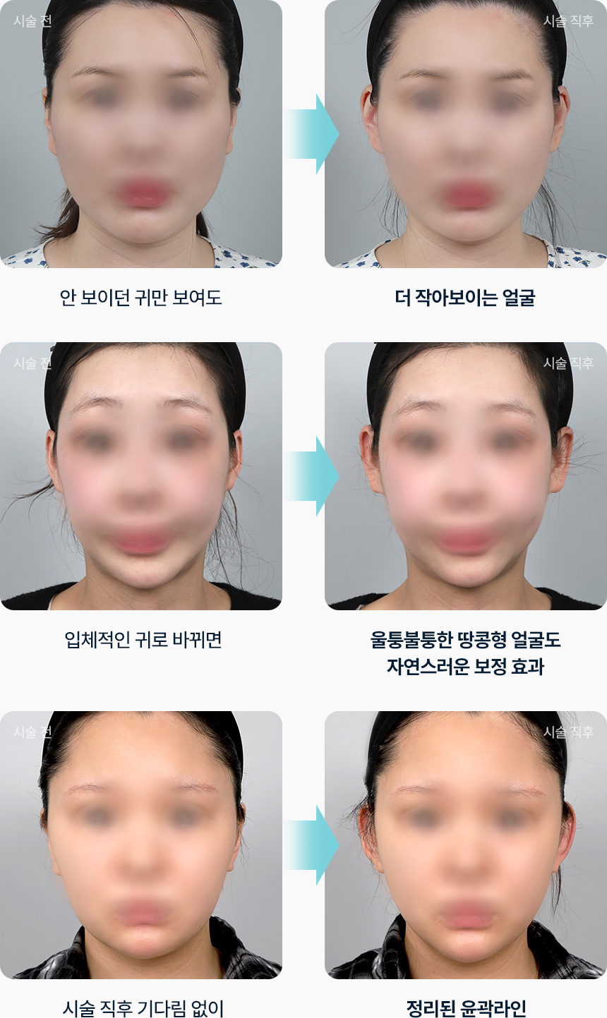 안 보이던 귀만 보여도 더 작아보이는 얼굴 입체적인 귀로 바뀌면 울퉁불퉁한 땅콩형 얼굴도 자연스러운 보정 효과 시술 직후 기다림 없이 정리된 윤곽라인