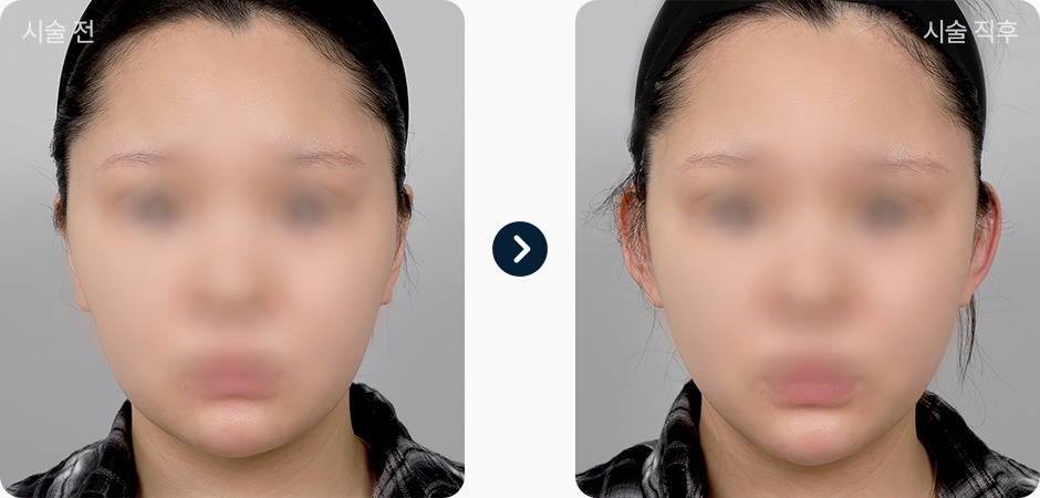 귀필러 전후사진 귀필러후기