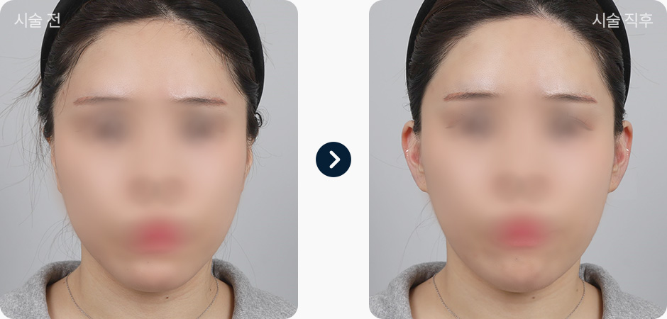 귀필러 전후사진 귀필러후기