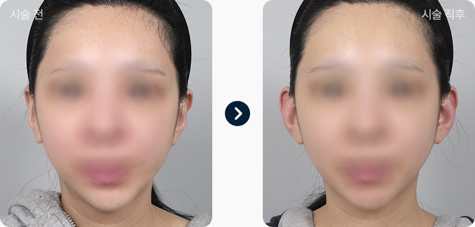 귀필러 전후사진 귀필러후기