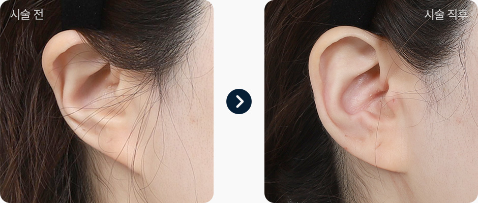 귀필러 전후사진 귀필러후기