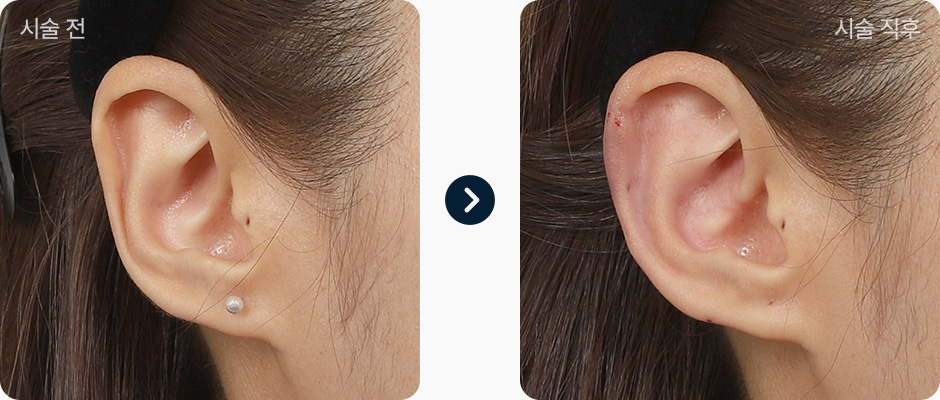 귀필러 전후사진 귀필러후기