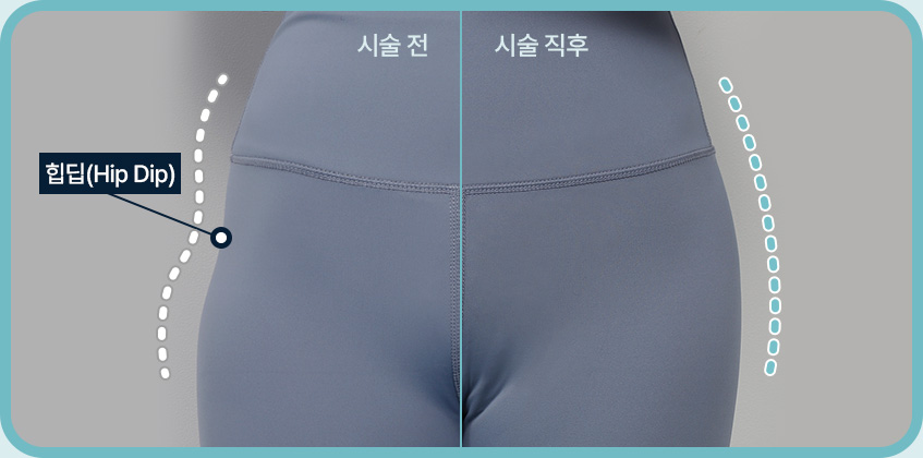 힙딥필러 시술전 시술후 시술후기