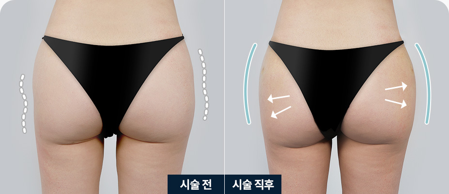 힙딥필러 골반 비대칭 엉덩이모양 비대칭 힙딥필러 전후